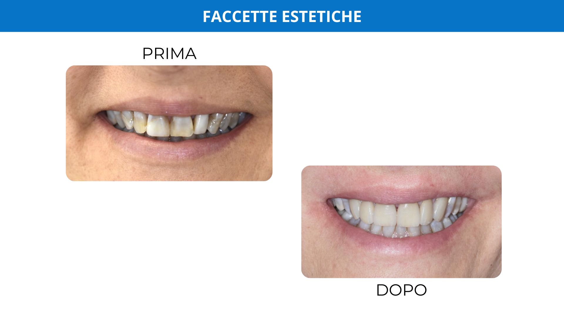 Faccette dentali: ritrovare il sorriso in modo naturale - Centro Dentistico  Romagnolo